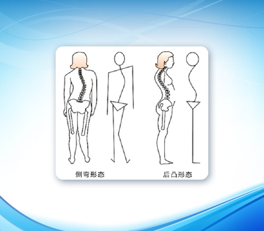 脊柱侧弯矫形器(图1)