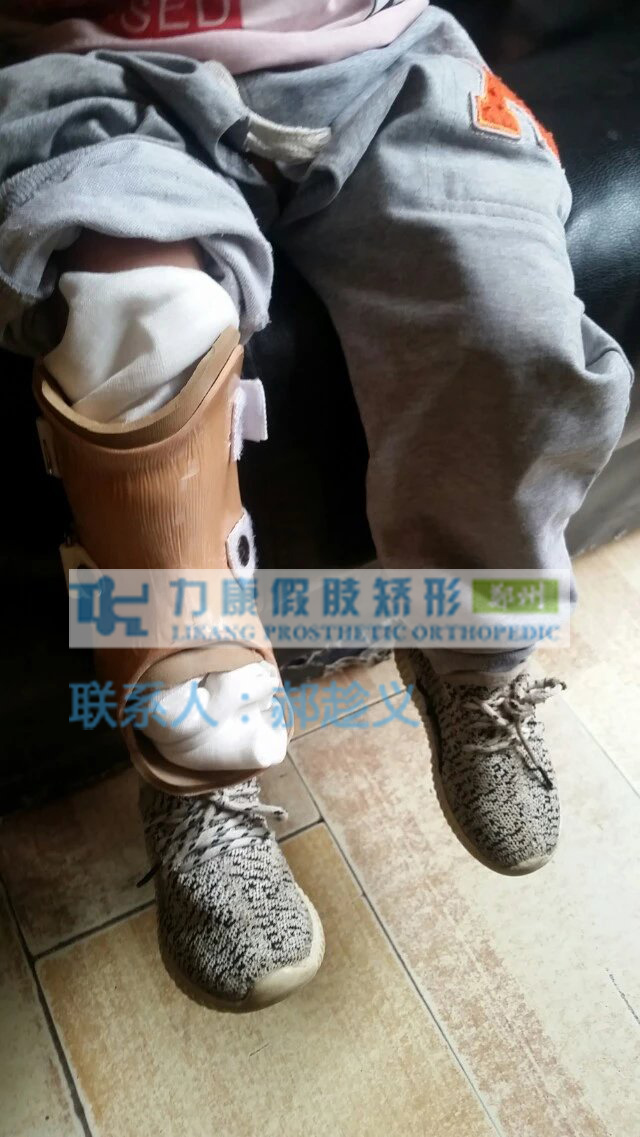 儿童畸形腿特制假肢(图1)