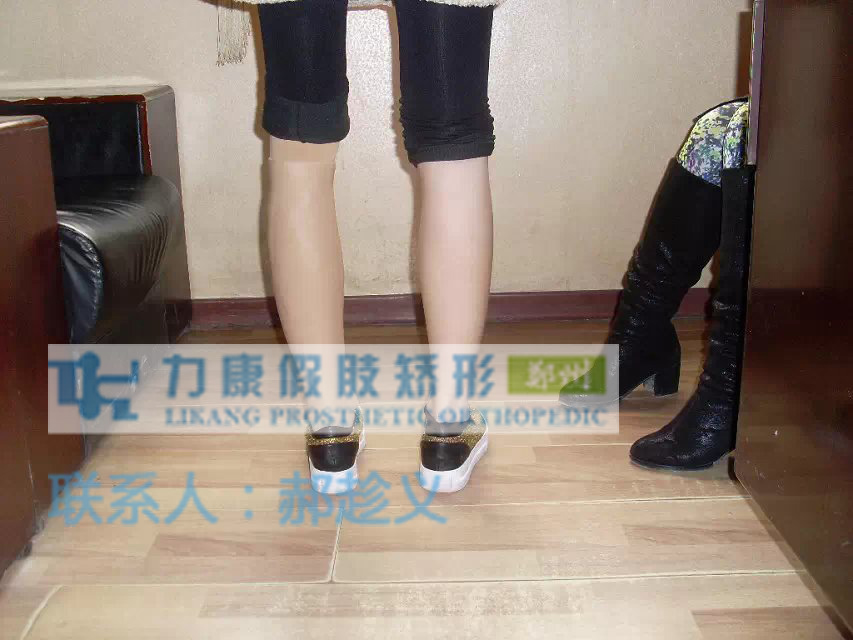 小腿（肌肉缺失）假肌肉(图1)
