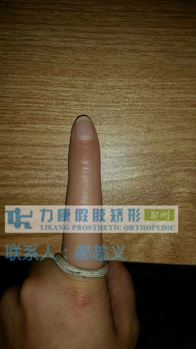 左食指假肢(图1)